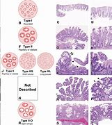Image result for Hyperplastic Colon Polyp