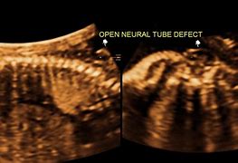 Image result for Open Neural Tube Defect