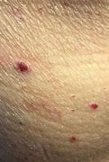 Image result for Red Papules On Skin