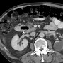 Image result for duodenal