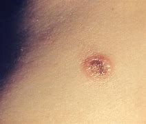 Image result for Molluscum in Adults
