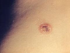 Image result for Molluscum Contagiosum in Groin Adult