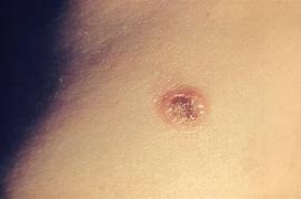 Image result for Molluscum Contagiosum HIV