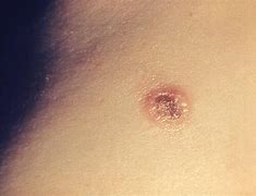 Image result for Molluscum Lesions