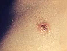 Image result for All Natural Molluscum Treatment