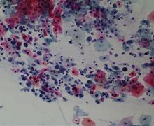Image result for Squamous Cell Carcinoma Cytology