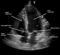 Image result for Echo Heart Ultrasound