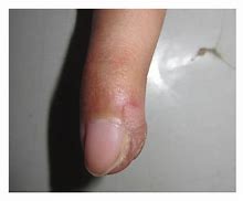 Image result for Periungual Wart