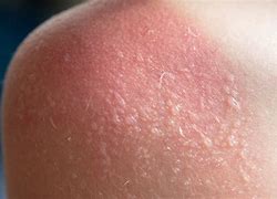 Image result for severe sunburn blisters