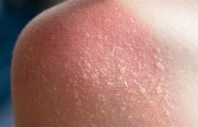 Image result for Severe Sunburn Blisters