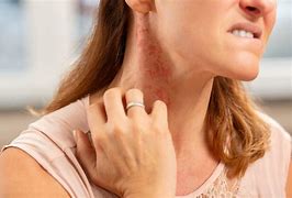 Image result for Allergic Reaction On Face and Neck