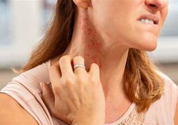 Image result for Skin Allergies