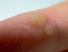 Image result for Wart vs Blister On Finger