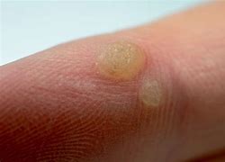 Image result for Wart On Arm