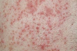 Image result for Skin Rash Dermatitis Eczema
