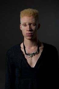 Результаты поиска изображений по запросу "albino model shaun ross nose". 