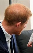Image result for Prince Harry Calvitie