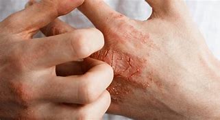Image result for Eczematous Dermatitis Pictures