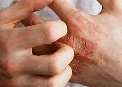 Image result for Eczema/Dermatitis