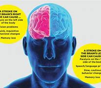Image result for Stroke Recovery Treatment