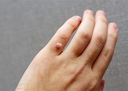Image result for What Is a Wart On Finger