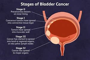 Image result for Bladder Cancer Cells