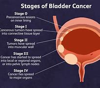 Image result for Papillary Bladder Cancer