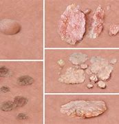 Image result for Genital Warts Cauliflower