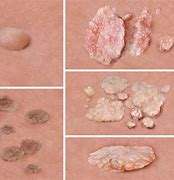 Image result for Genital Warts Cure