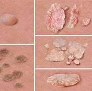 Image result for Warts Gentual