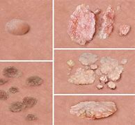 Image result for Genital Warts for Men