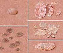 Image result for Genital Wart Treatment Disease
