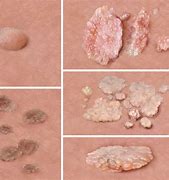 Image result for Genital Warts