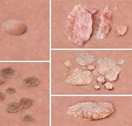 Image result for Genital Warts Early Stage