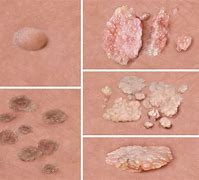 Image result for Male Genital Warts Disease