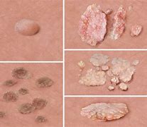 Image result for Male Genital Warts Stages