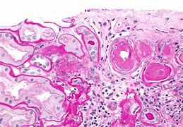 Image result for Renal Hyalinosis