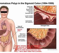 Image result for Burning Polyps in Colon