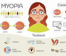 Image result for Myopia