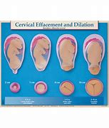 Image result for 5 Cm Dilated