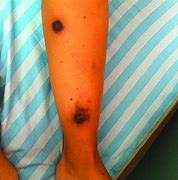 Image result for Moisture Lesion Necrotic