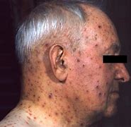 Image result for Chickenpox in Adults