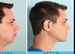 Image result for Jawline Plastic Surgery