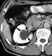 Image result for Renal Sinus Cyst