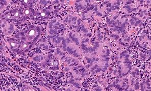 Image result for How Large Is 8Mm Tumor