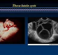 Image result for Theca Lutein Cysts of Pregnant Ultrasounds
