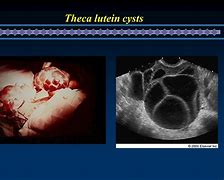 Image result for Theca Lutein Cyst
