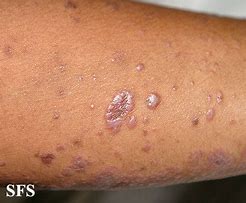 Image result for Lichen Planus Skin Disease
