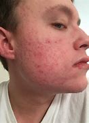 Image result for acne