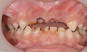 Image result for Toddler Rotting Teeth